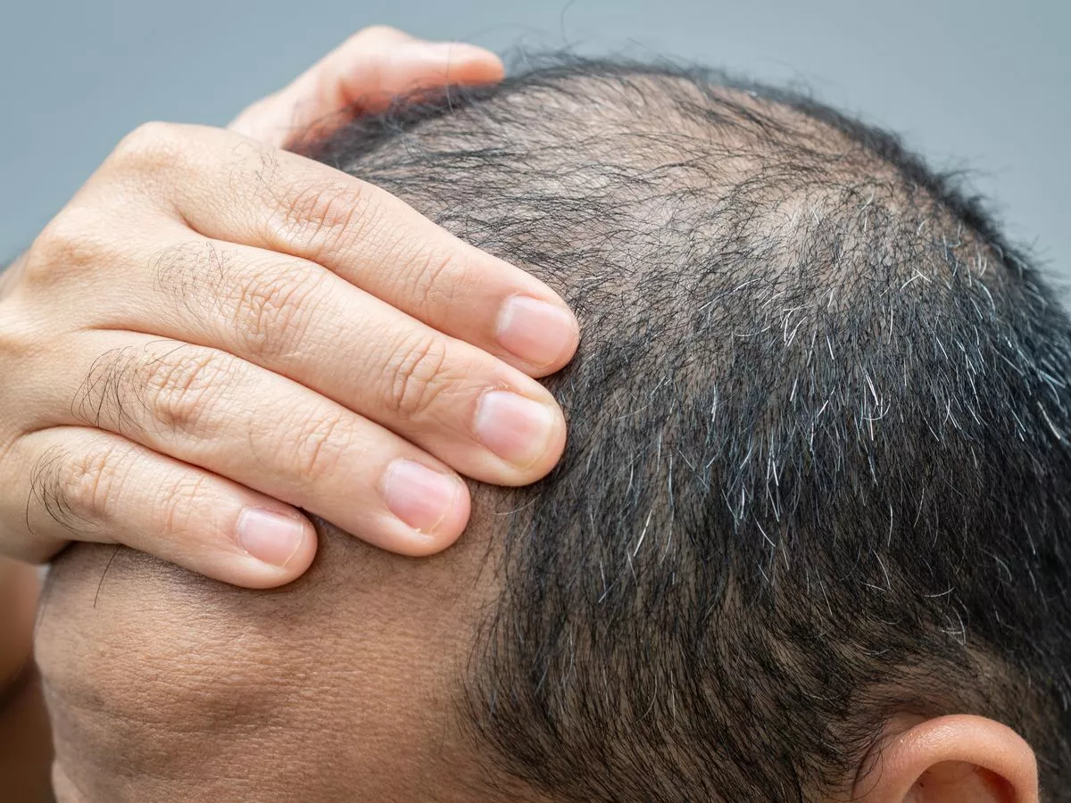 Read more about the article هل الشعر الخفيف مشكلة وراثية؟ وكيف يمكن تحويله لشعر كثيف؟